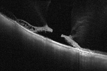 Разрывы сетчатки глаза