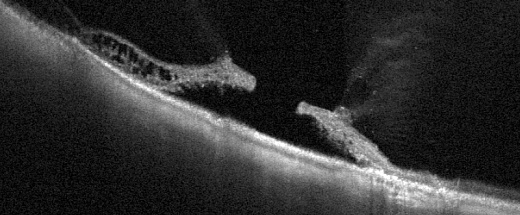 разрыв сетчатки глаза