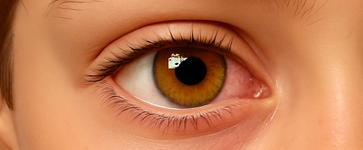 Конъюнктивит у детей: чем лечить и как не допустить осложнений