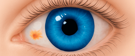 Пятно на белке глаза