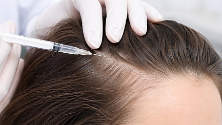 Мезотерапия волос: как инъекции останавливают выпадение и пробуждают спящие фолликулы