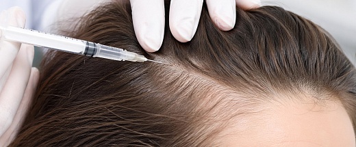 Мезотерапия волос: как инъекции останавливают выпадение и пробуждают спящие фолликулы